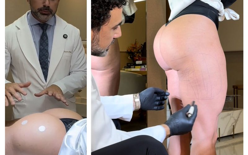 Juju Salimeni aposta em bioestimulador para manter bumbum firme