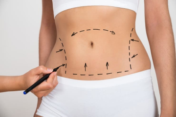 Abdominoplastia x Lipoaspiração: Entenda as Diferenças e Indicações