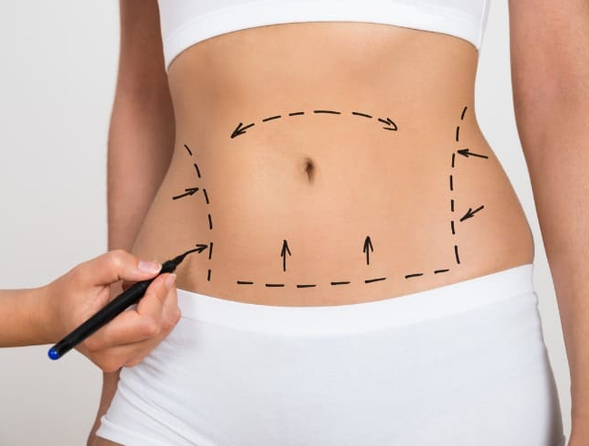 Abdominoplastia x Lipoaspiração: Entenda as Diferenças e Indicações