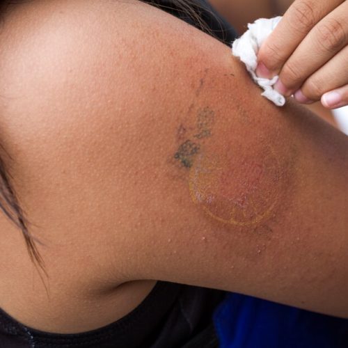 Tendência em Estética: Remoção de Tatuagem a Laser é o Procedimento da Vez nas Clínicas Premium