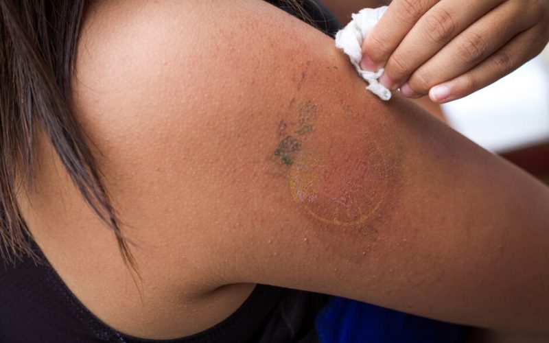 Tendência em Estética: Remoção de Tatuagem a Laser é o Procedimento da Vez nas Clínicas Premium