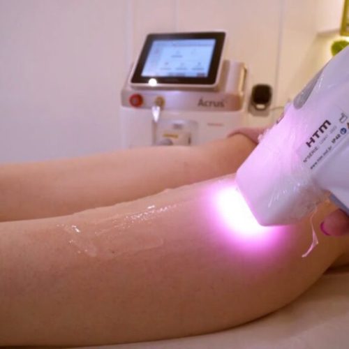 Laser de Epilação: A Nova Alternativa Eficiente Contra os Métodos Convencionais de Depilação