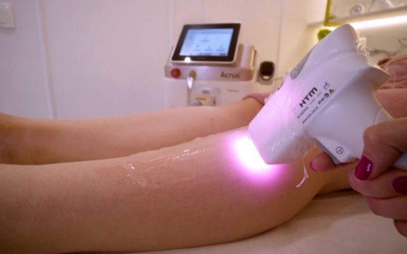Laser de Epilação: A Nova Alternativa Eficiente Contra os Métodos Convencionais de Depilação