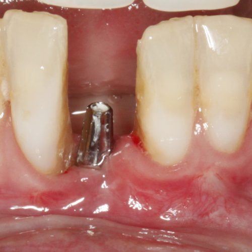 O que o tempo faz com quem perde os dentes