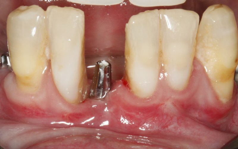 O que o tempo faz com quem perde os dentes